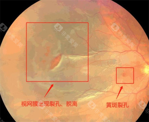 孔源性视网膜脱离的不同病症图
