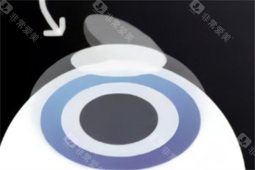博鳌眼科项目收费标准表公布，近视手术8819起/白内障5625起/斜视5692起！