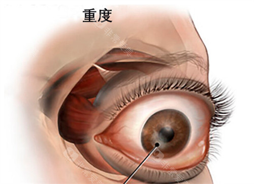 甲亢突眼眼球的表现图解