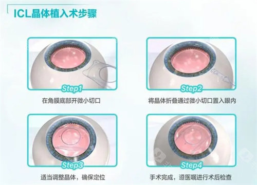 济南晶体植入手术多少钱?哪家医院能做?点击看可预约医院名单!