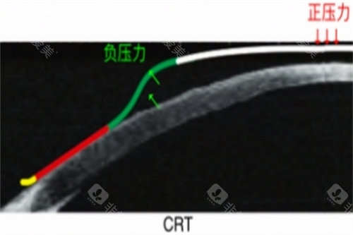 CRT角膜塑形镜力的示意图