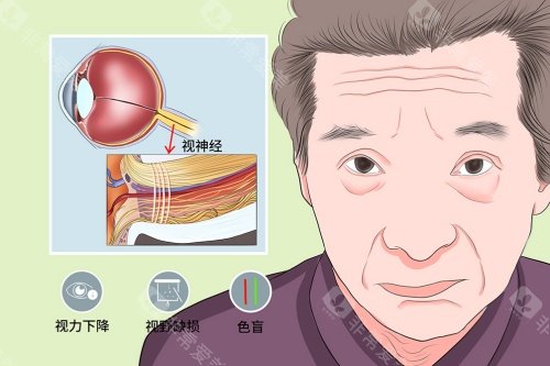 网选国内视神经萎缩医院排名前十:吉林恒达眼科/成都中银海眼科/爱尔眼科/华厦眼科技术好!