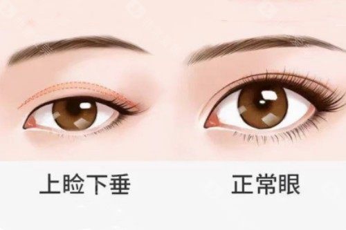 正常眼睛和上睑下垂眼睛对比图
