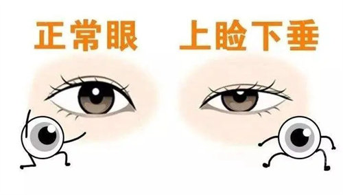正常眼和上睑下垂