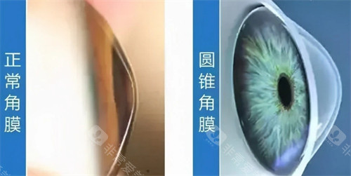 圆锥角膜和正常角膜的区别图解
