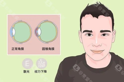 圆锥角膜症状图