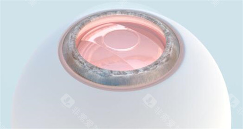 兰州近视手术价格：兰州爱尔/兰州普瑞等飞秒手术价格参考