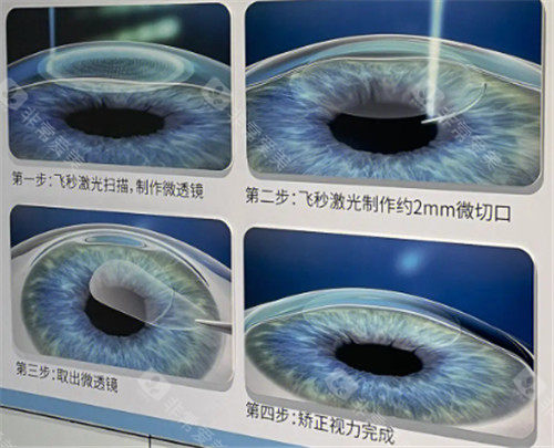 海南省眼科医院收费标准公布，近视手术11800起/白内障4400起/青光眼2080起！