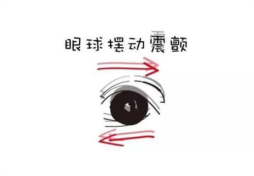 眼球震颤卡通图展示照片
