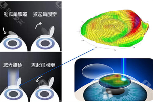 激光近视手术过程示意图