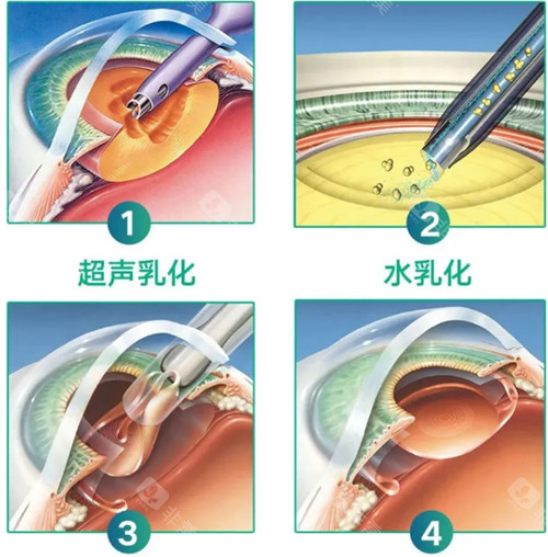 免费白内障手术可靠吗，文中从多个方面探讨免费白内障手术的可靠性！