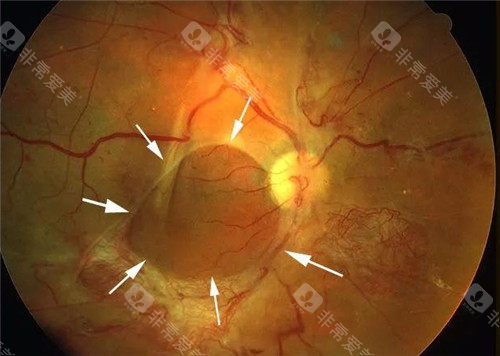 上海眼科医院视网膜脱落选哪家？推荐眼科有和平眼科、沪申五官科眼科、医大医院眼科~
