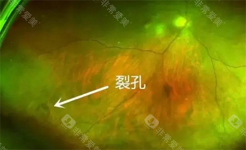孔源性视网膜脱离裂孔部位
