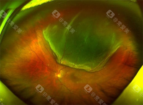 孔源性视网膜脱离细节