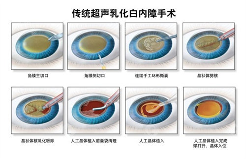 万宁白内障手术多少钱，传统白内障手术3200起/白内障超声乳化手术5000起！