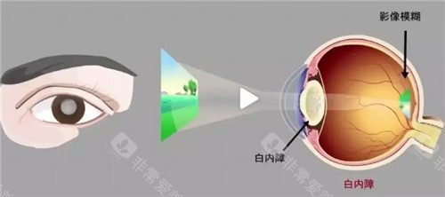 东方白内障手术多少钱，超声乳化手术5000起/飞秒激光辅助手术15000起！