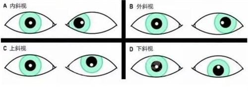 石家庄斜视手术多少钱?手术方案3900-1.72W元起,住院开销+检查项目+手术花费明细全呈现！（包含智能斜视修复术等技术）