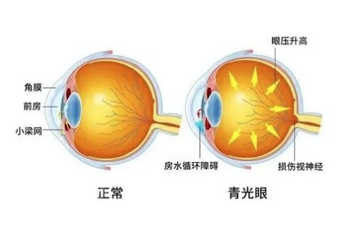 汕头青光眼手术价格表查看，青光眼小梁切除术4300起/继发性青光眼手术6600起！
