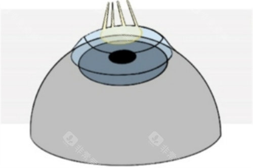 Refractive-Surgery-Techniques-1024x493_副本