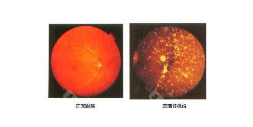 玻璃体浑浊和正常眼底的对比