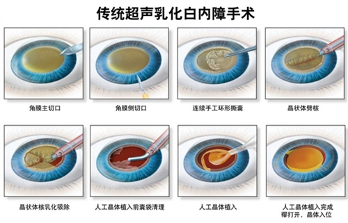 本溪白内障手术哪家医院好？爱尔眼科手术量大口碑好 很推荐！