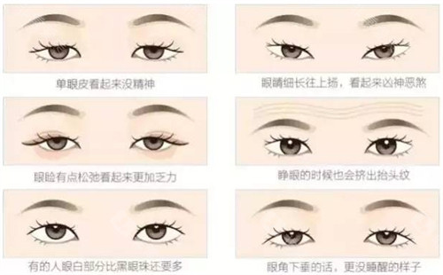 不同可以进行双眼皮的眼睛