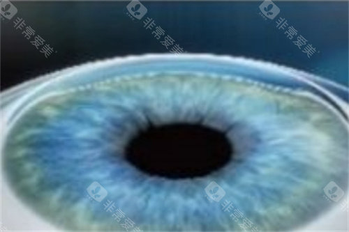 全飞秒手术结束