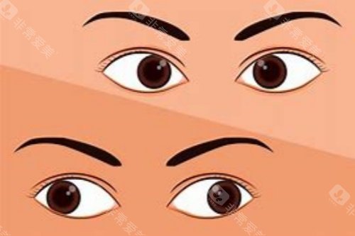 内斜视对比外斜视