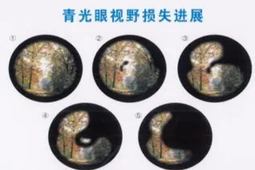 铜梁人民医院眼科做青光眼手术好吗？本地老牌医院，激光手术可靠，年手术量多！