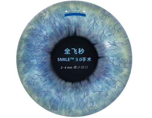 遵义做近视激光手术要多少钱？全新价目表：全飞秒1.8万，半飞秒1.2万，表层激光8500元起！