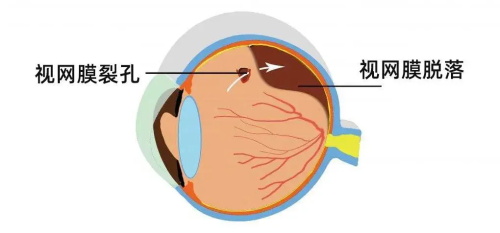 西安第四医院眼科孙文涛医生简介预约入口：复杂视网膜病医师_糖尿病视网膜病变+高度近视眼病可治