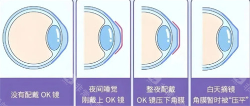 角膜塑形镜佩戴前后对比图