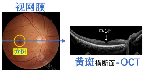 黄斑眼病横切面的样子图解