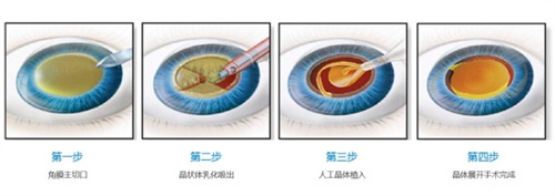 衡水看老年眼睛的医院哪家好?爱尔VS华厦眼科实测,长辈白内障/老花诊疗口碑佳