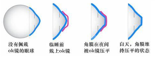 角膜塑形镜多少钱