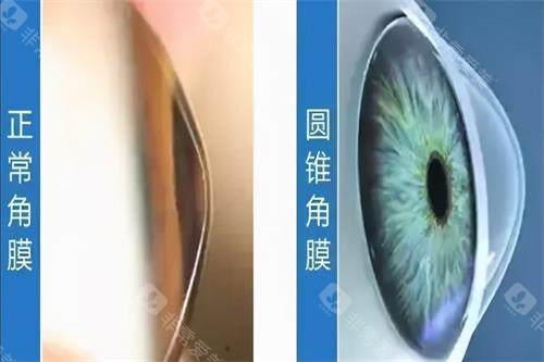 圆锥角膜和正常角膜的区别