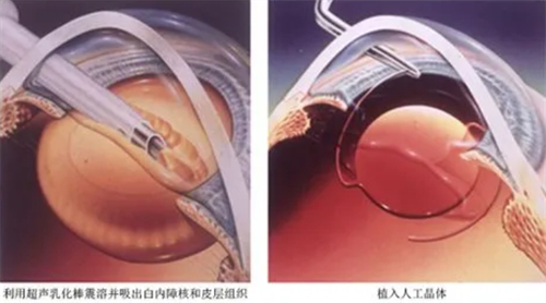 割白内障手术要多少钱？附2025年白内障手术各费用详细价格明细一览！