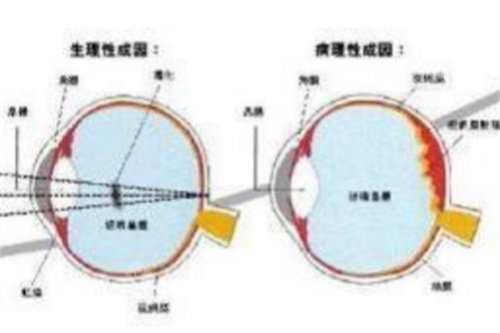 不同原因飞蚊症对比