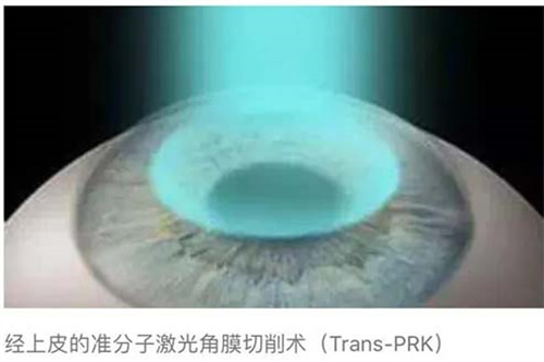 当兵近视眼手术费用报销吗？手术费用10000-35000元起？军属/毕业生专属优待措施大盘点！