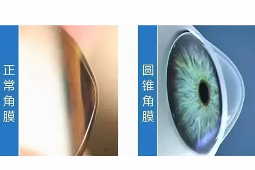 角膜交联手术做后感受：除了疼痛，这些术后反应你也需要知道！