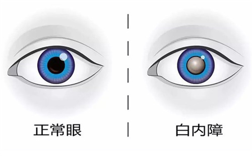 青岛白内障手术多少钱？超声乳化5000元起，附单焦点/多焦点晶体价格