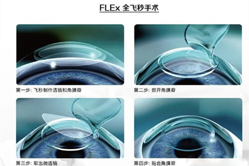 成都双楠医院眼科做近视手术怎么样，多少钱，技术出色价格8000元起！