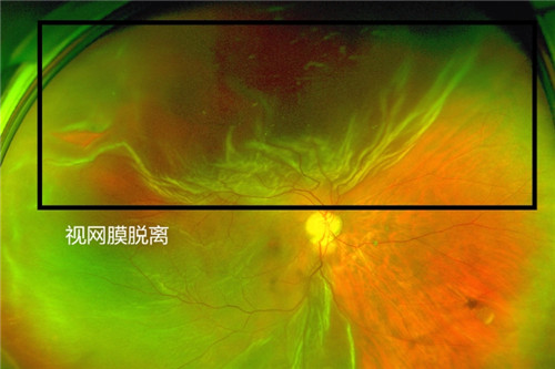 南京做视网膜脱落手术的医院哪个好？推荐眼科有维视眼科、华夏眼科、东南眼科！