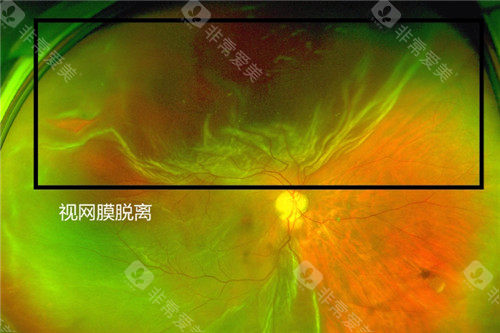 视网膜脱离照片