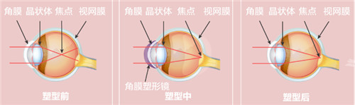 成都配角膜塑形镜哪个医院好？佰视佳、睛彩眼科、普瑞眼科这几家大家都随意选！