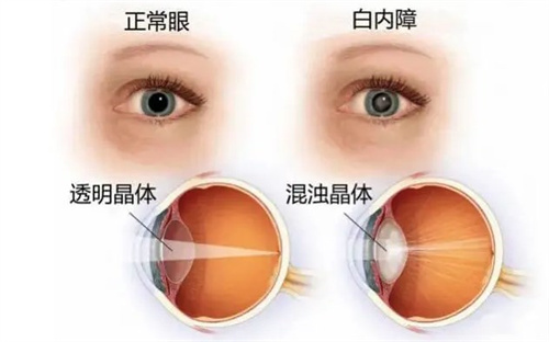 开封爱尔眼科白内障手术多少钱？单焦点晶体8000元起/单眼、双焦点晶体10000-40000元起、三焦点晶体25000元起