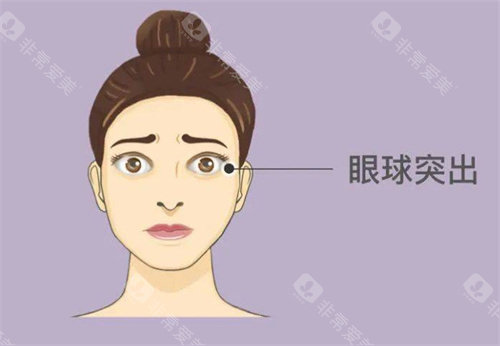 甲亢突眼症状