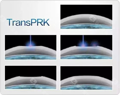 TPRK近视手术示意图