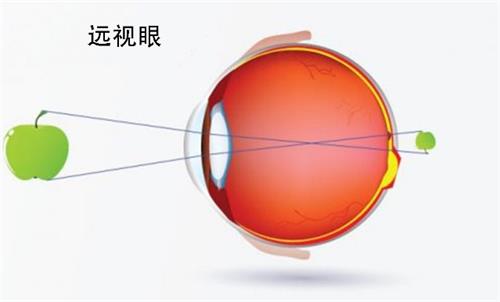 上海眼科检查医院哪家好?浦东爱尔眼科医院是朋友推荐给我的,验光准还不贵!