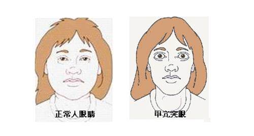 正常眼睛和突眼的对比